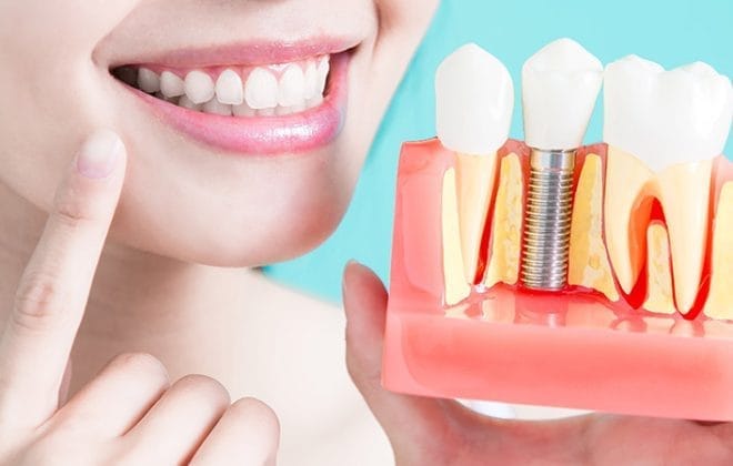 Advantages of dental implants