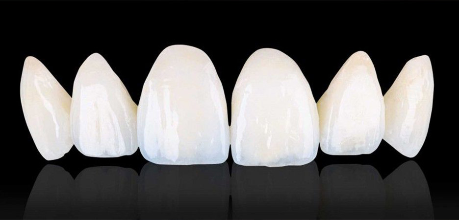 Composite Veneers - Lara Smile Dental Clinic