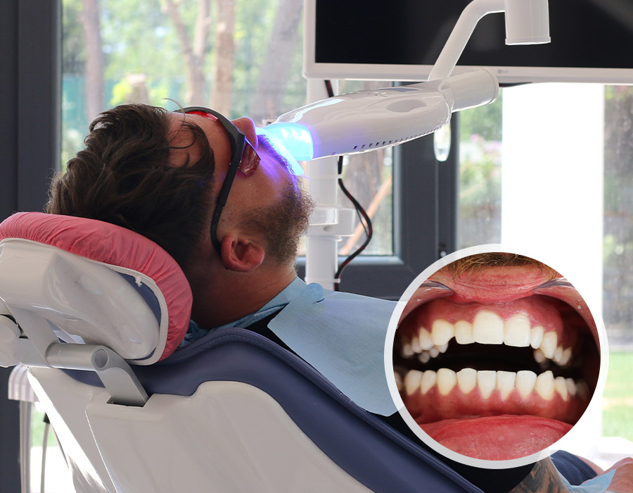Blanchiment des dents Clinique Dentaire Medworld