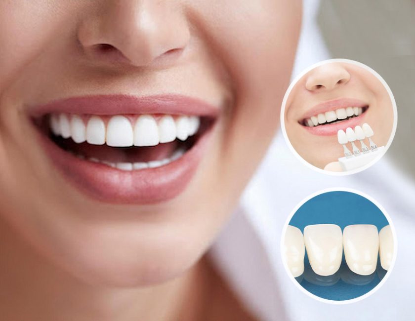 ᐈ Carillas Dentales en Santiago - Clínica Dental OnSmile