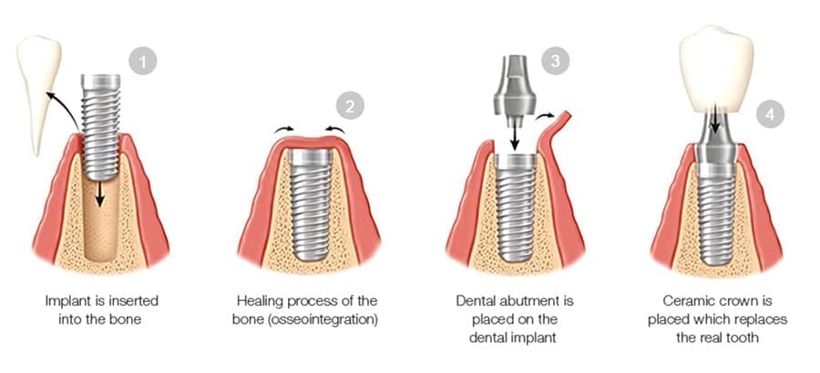 Как проходит имплантация зубов