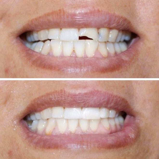 lara-smile-dental-before-after-30