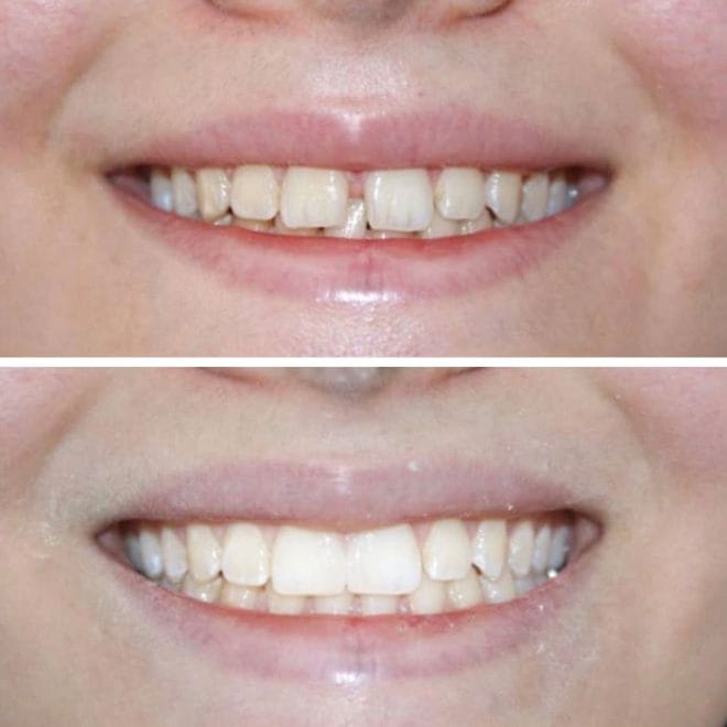 lara-smile-dental-before-after-32