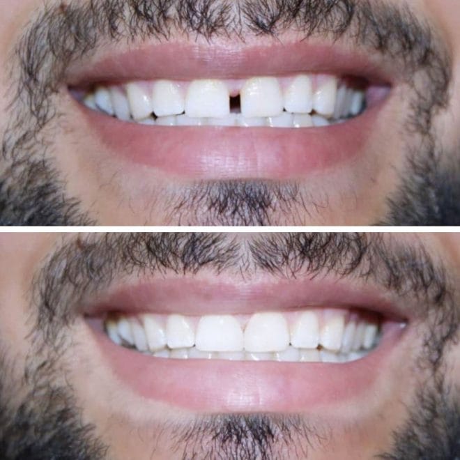 lara-smile-dental-before-after-34