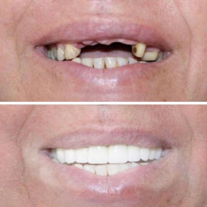 lara-smile-dental-before-after-36