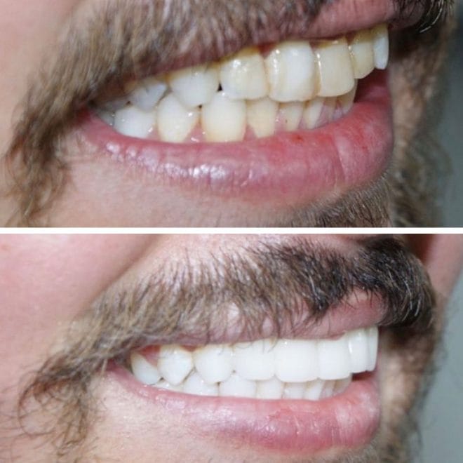 lara-smile-dental-before-after-38