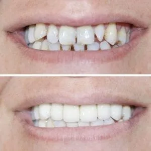 Dental Implants - Lara Smile Dental Clinic