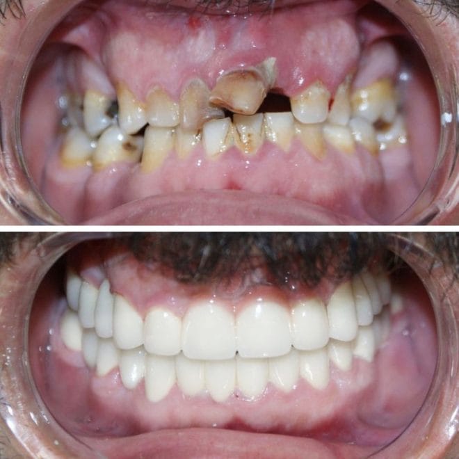 lara-smile-dental-before-after-41