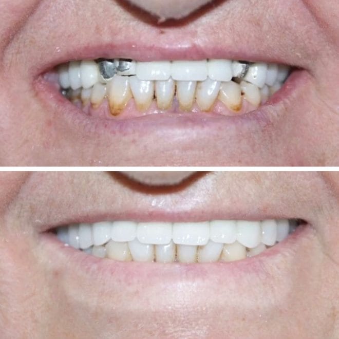 lara-smile-dental-before-after-42