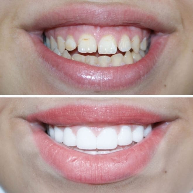 lara-smile-dental-before-after-46