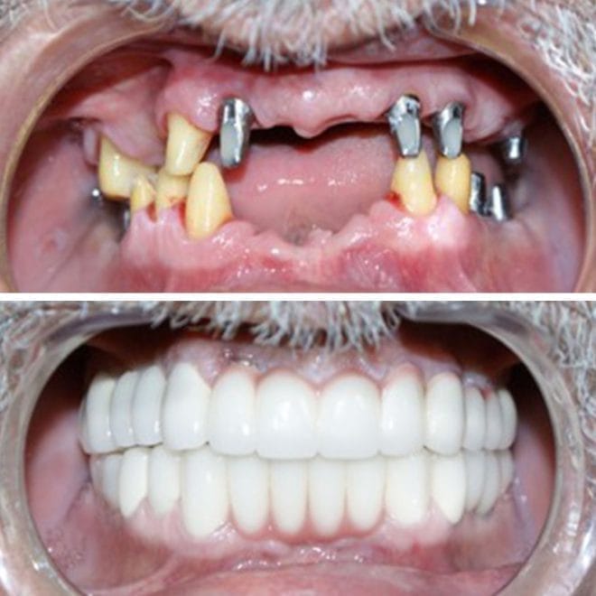 lara-smile-dental-before-after-47