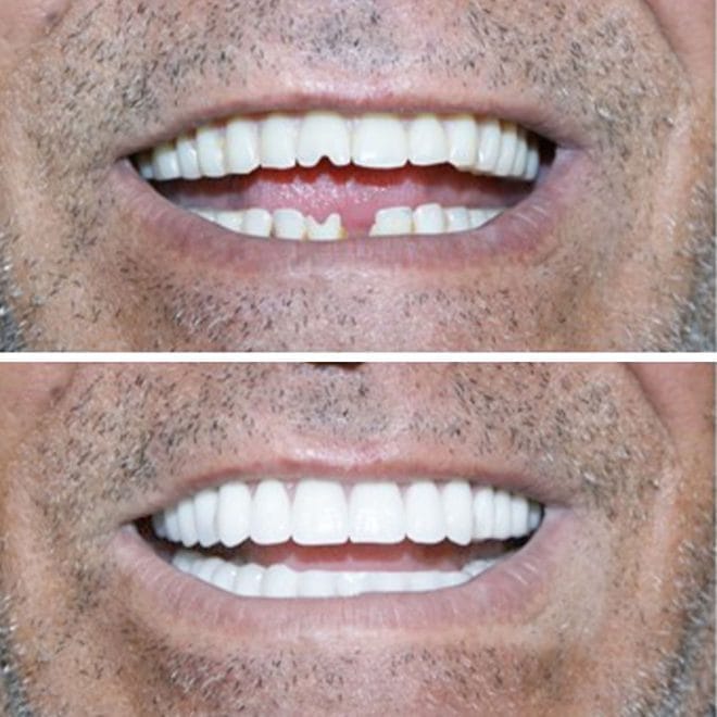 lara-smile-dental-before-after-51