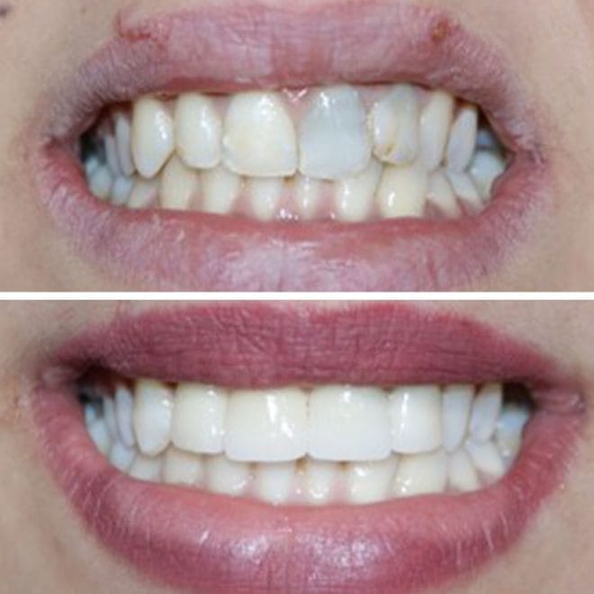 lara-smile-dental-before-after-52