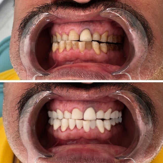 lara-smile-dental-before-after-65