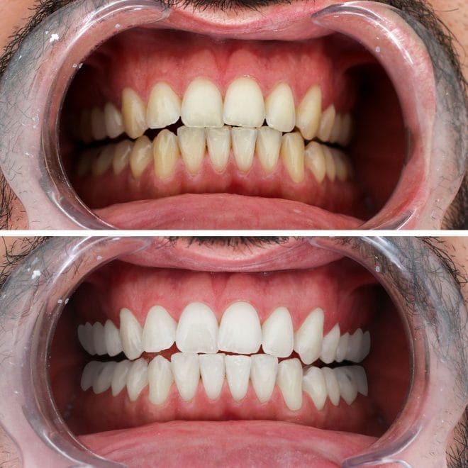 lara-smile-dental-before-after-67