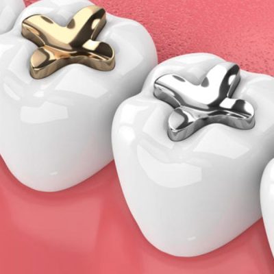 tooth-Metal-Fillings