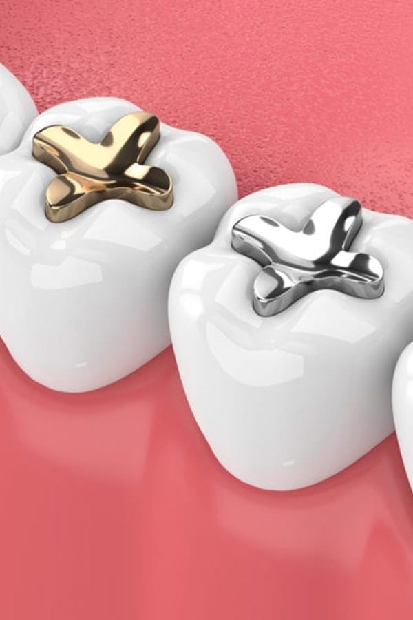 tooth Metal Fillings