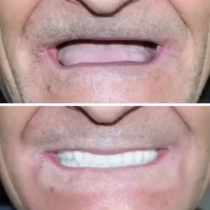 dental implants before after photos