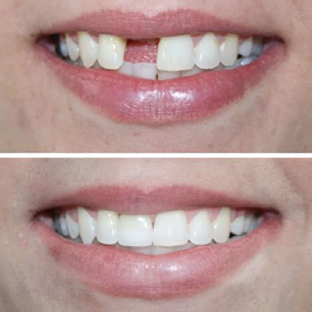 dental implants before after