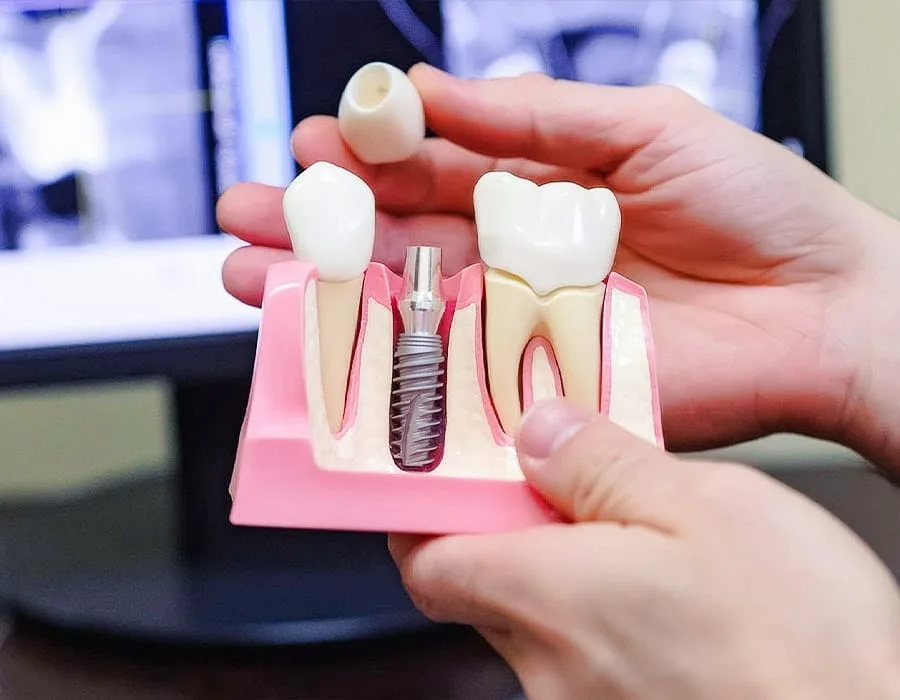 dental implants