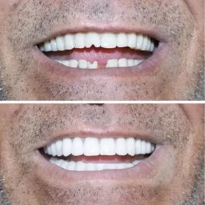 dental veneers before after