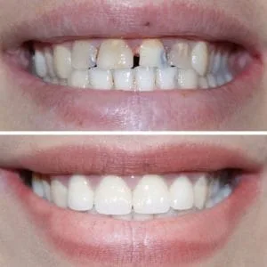 dental veneers before after photo