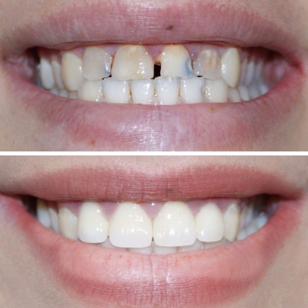 Carillas dentales - Vuelve a Sonreír con confianza – CLINY FARMY