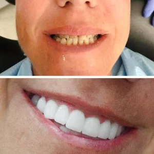 hollywood smile before after