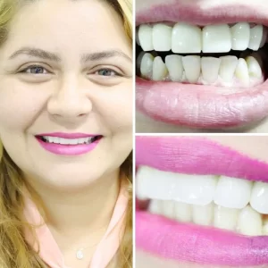 hollywood smile before after