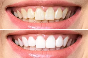 teeth whitening before after