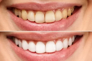 teeth whitening before after photo