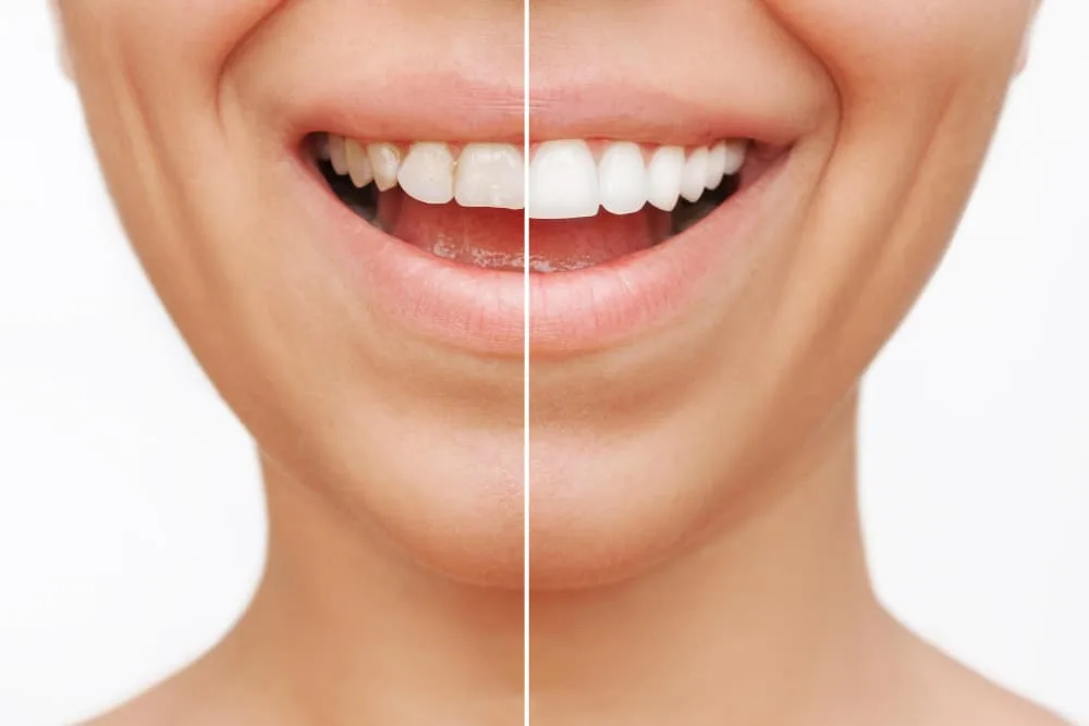 veneers before after