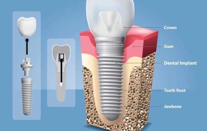 dental implant materials