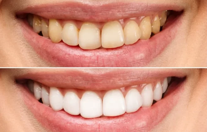 tooth discoloration