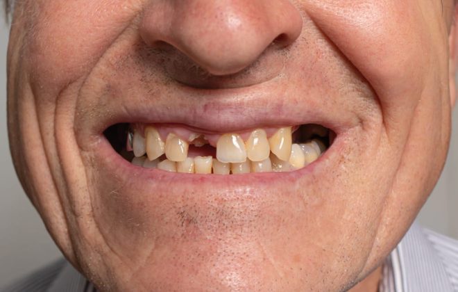 options for missing teeth