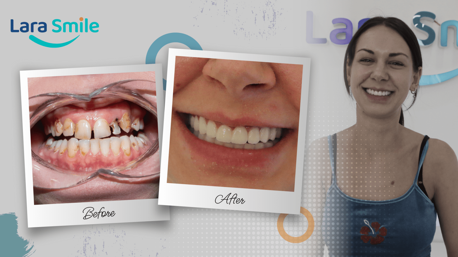 Before & After - Lara Smile Dental Clinic Antalya, Turkey