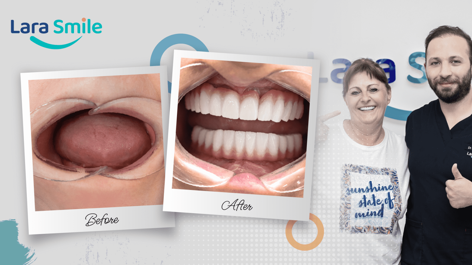 Before & After - Lara Smile Dental Clinic Antalya, Turkey