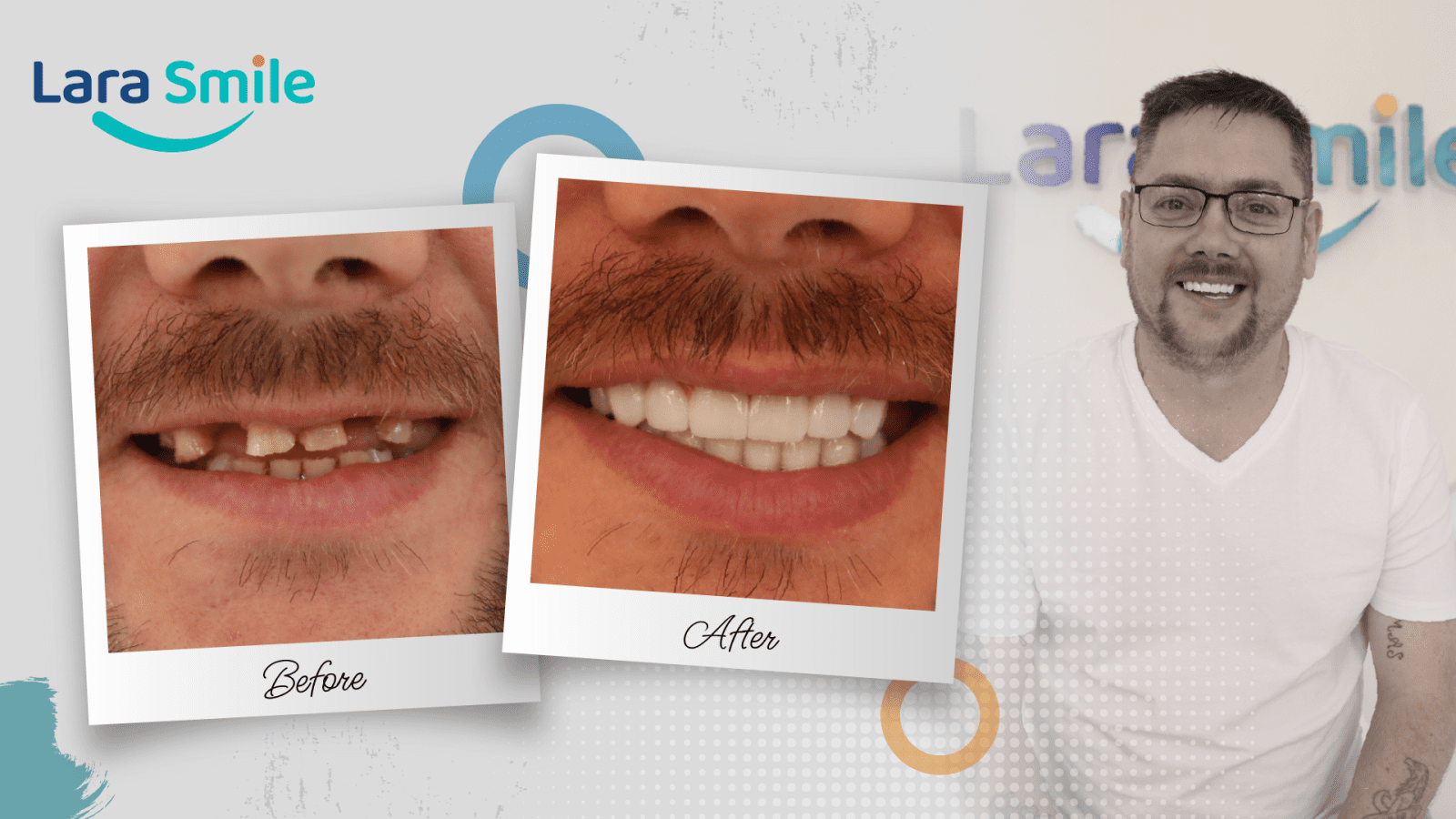 Before & After - Lara Smile Dental Clinic Antalya, Turkey