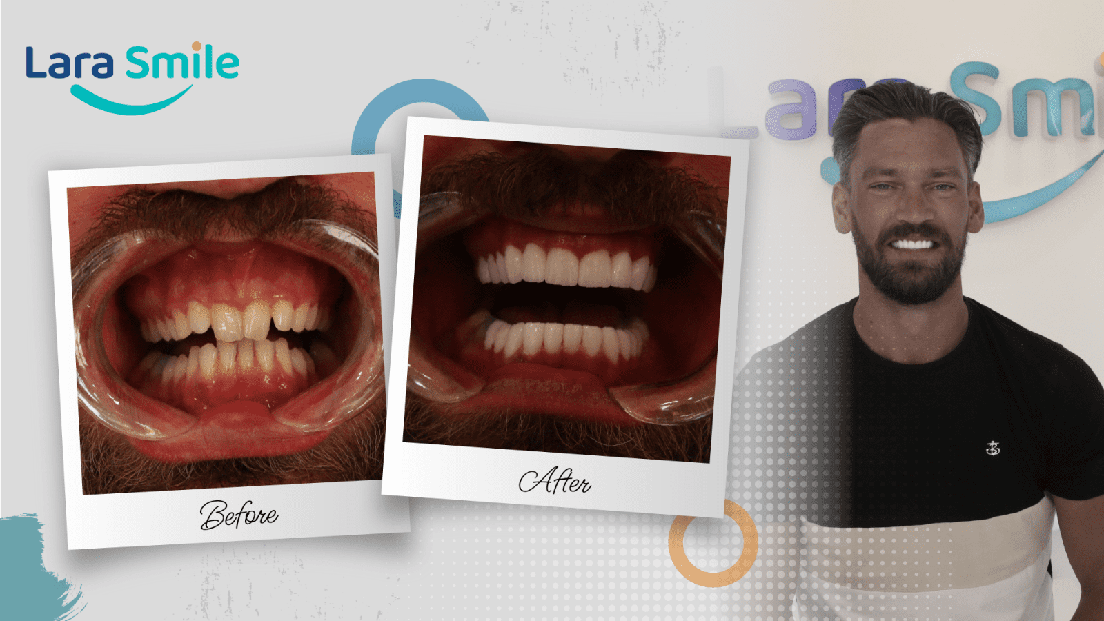 Before & After - Lara Smile Dental Clinic Antalya, Turkey