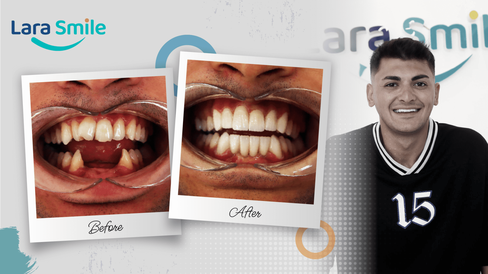 Before & After - Lara Smile Dental Clinic Antalya, Turkey