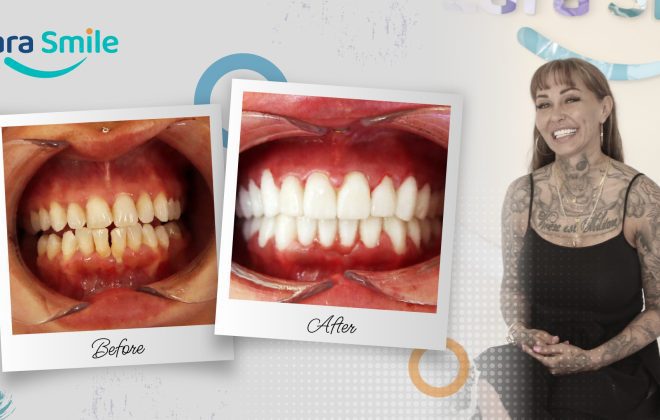 Before & After - Lara Smile Dental Clinic Antalya, Turkey