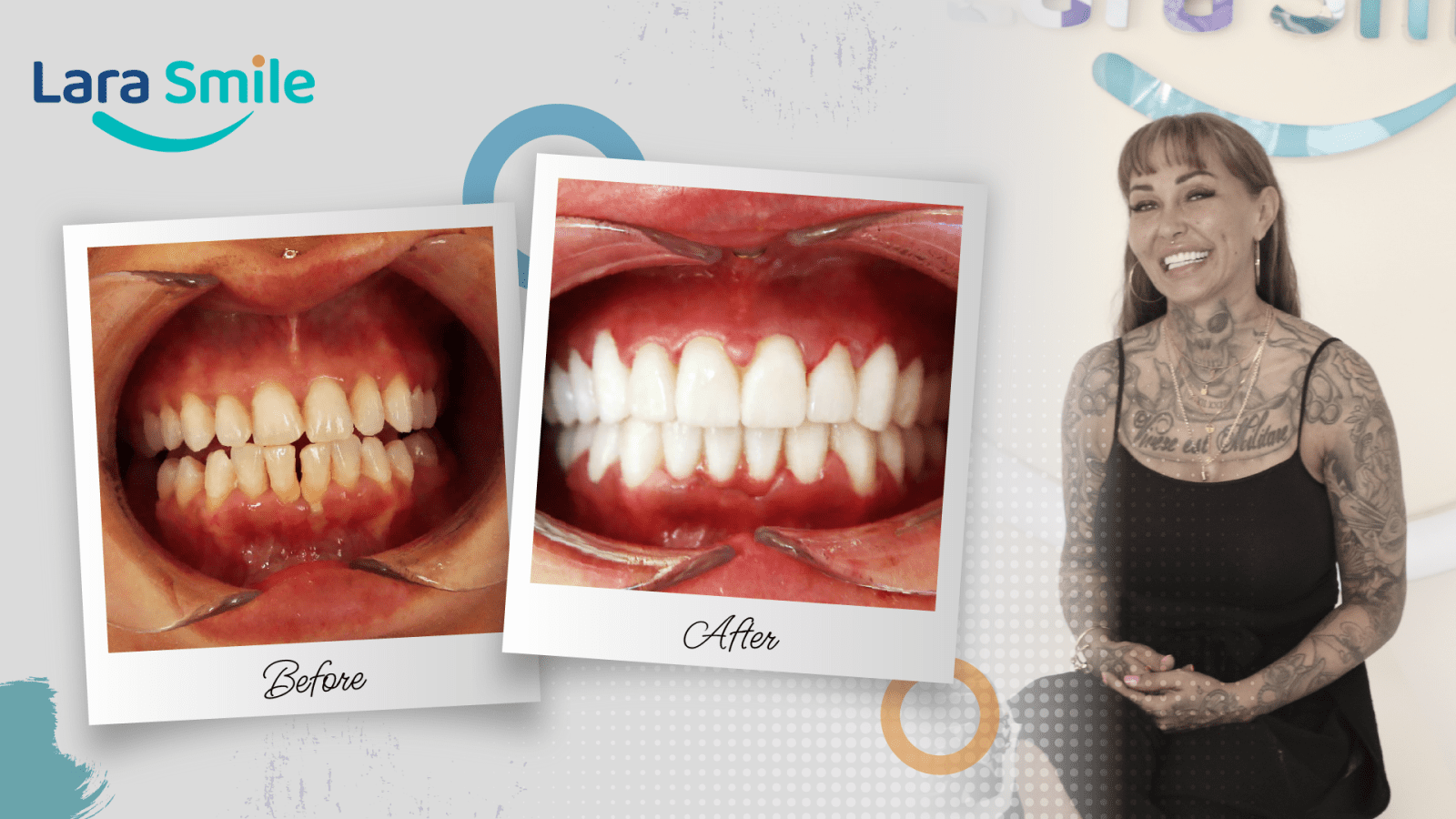 Before & After - Lara Smile Dental Clinic Antalya, Turkey