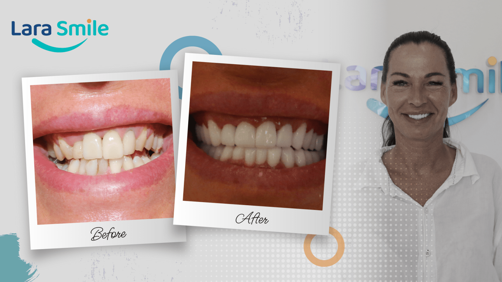 Before & After - Lara Smile Dental Clinic Antalya, Turkey