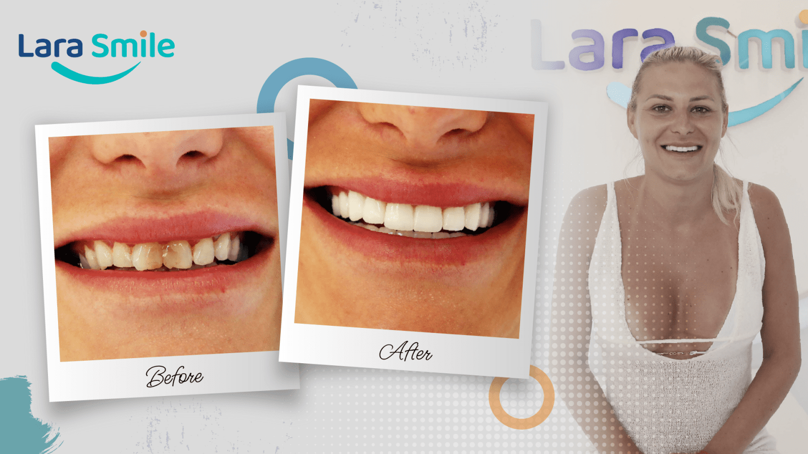 Before & After - Lara Smile Dental Clinic Antalya, Turkey