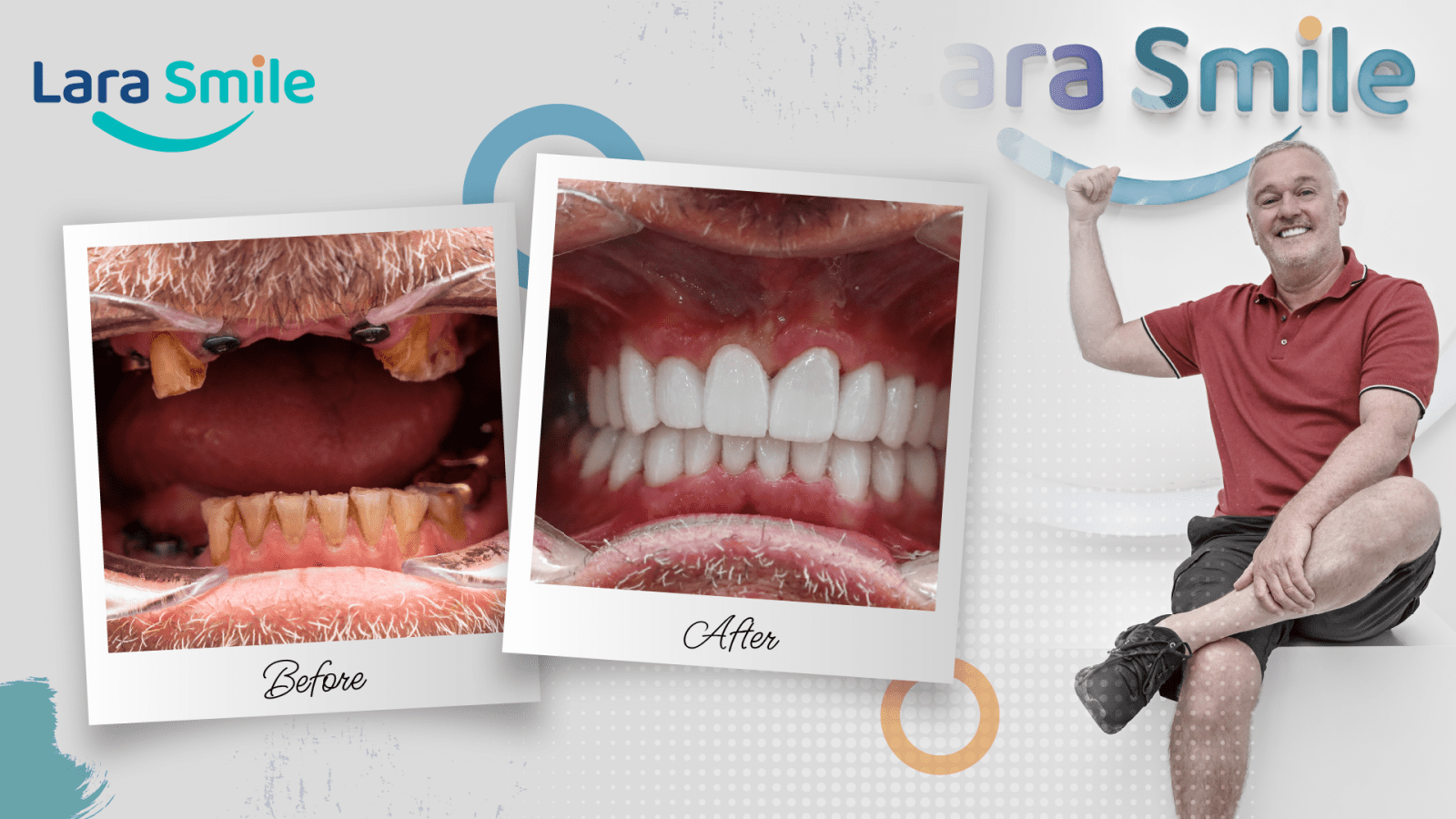 Before & After - Lara Smile Dental Clinic Antalya, Turkey