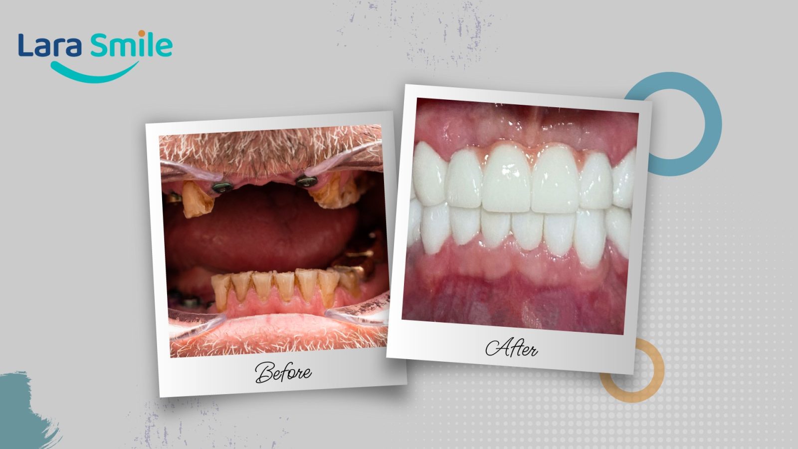 Before & After - Lara Smile Dental Clinic Antalya, Turkey