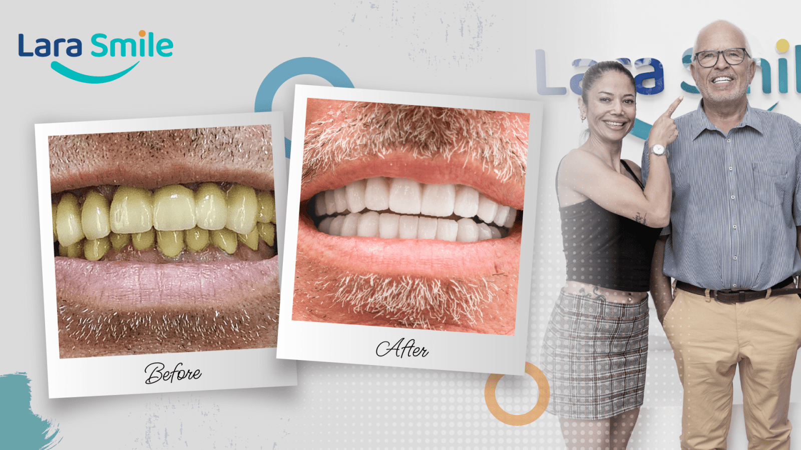 Before & After - Lara Smile Dental Clinic Antalya, Turkey