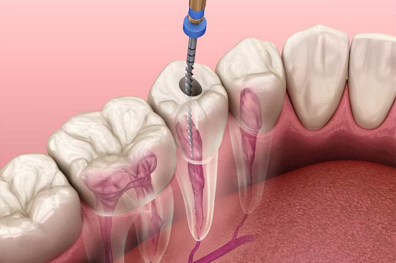 Root Canal Treatment