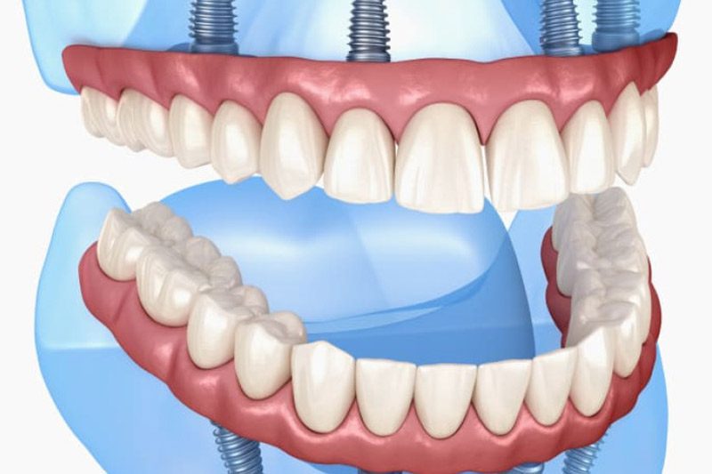 all on 4 dental implants