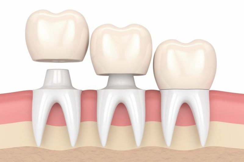 dantal crowns 1